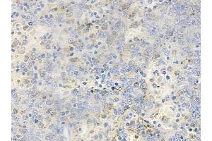 ABIN6256653 and ABIN6267393 at 1/100 staining human melanoma by IHC-P.