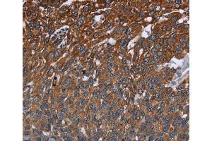 Immunohistochemistry of Human cervical cancer using FCGR3A Polyclonal Antibody at dilution of 1:40 (FCGR3A anticorps)