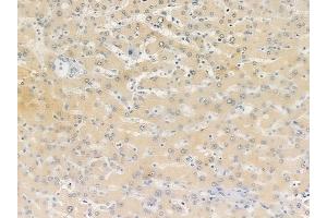 ABIN6257348 and ABIN6274717 at 1/100 staining human hepatocellular carcinoma by IHC-P.