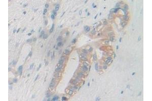 Detection of PYGB in Human Bile duct cancer Tissue using Polyclonal Antibody to Glycogen Phosphorylase, Brain (PYGB)