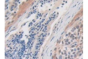 Detection of USP7 in Human Skin cancer Tissue using Polyclonal Antibody to Ubiquitin Specific Peptidase 7 (USP7)