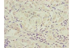 Immunohistochemistry of paraffin-embedded human gastric cancer using ABIN7170271 at dilution of 1:100