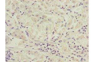 Immunohistochemistry of paraffin-embedded human gastric cancer using ABIN7170271 at dilution of 1:100 (GPR172B anticorps  (AA 212-279))