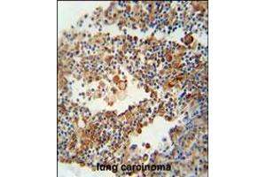 OR9Q1 antibody immunohistochemistry analysis in formalin fixed and paraffin embedded human lung carcinoma followed by peroxidase conjugation of the secondary antibody and DAB staining. (OR9Q1 anticorps  (C-Term))