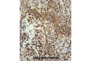 ZNF667 Antibody (Center) immunohistochemistry analysis in formalin fixed and paraffin embedded human lung carcinoma followed by peroxidase conjugation of the secondary antibody and DAB staining. (ZNF667 anticorps  (Middle Region))