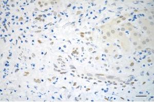 Immunohistochemistry was performed on paraffin-embedded human hepatocarcinoma using CSE1L like antibody (ABIN7798171), 1:200). (Exportin 2 anticorps)