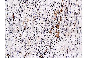 Formalin-fixed and paraffin embedded human colon carcinoma with Anti-Maspin Polyclonal Antibody, Unconjugated (ABIN728233) at 1:200, followed by conjugation to the secondary antibody and DAB staining (SERPINB5 anticorps  (AA 301-375))