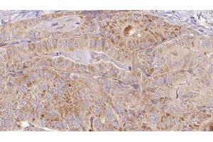 ABIN6267101 at 1/100 staining Human thyroid cancer tissue by IHC-P. (CAMKII gamma anticorps  (pTyr231))