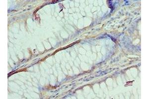 Immunohistochemistry of paraffin-embedded human colon cancer using ABIN7144363 at dilution of 1:100 (AP2B1 anticorps  (AA 738-937))