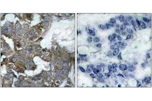 Immunohistochemistry analysis of paraffin-embedded human breast carcinoma tissue, using IkappaB-alpha (Ab-32/36) Antibody. (NFKBIA anticorps  (AA 15-64))