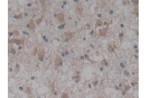 Detection of NTRK3 in Human Glioma Tissue using Polyclonal Antibody to Neurotrophic Tyrosine Kinase Receptor Type 3 (NTRK3)