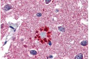 Human Brain, Cortex, Senile Plaque (formalin-fixed, paraffin-embedded) stained with TCF21 antibody ABIN462190 followed by biotinylated goat anti-rabbit IgG secondary antibody ABIN481713, alkaline phosphatase-streptavidin and chromogen.