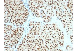Formalin-fixed, paraffin-embedded human Melanoma stained with SOX10 Mouse Monoclonal Antibody (SOX10/991). (SOX10 anticorps  (AA 115-269))