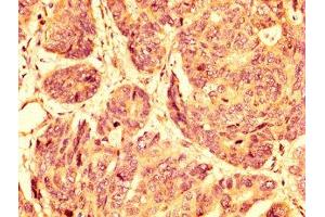 IHC image of ABIN7164493 diluted at 1:500 and staining in paraffin-embedded human gastric cancer performed on a Leica BondTM system.