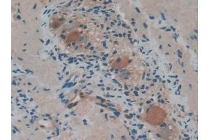 Detection of FOXO1 in Human Stomach cancer Tissue using Polyclonal Antibody to Forkhead Box Protein O1 (FOXO1)