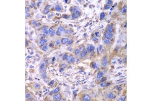 Immunohistochemistry of paraffin-embedded human esophageal cancer using SDHA antibody. (SDHA anticorps  (AA 385-664))