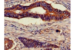 Immunohistochemistry of paraffin-embedded human colon cancer using ABIN7144852 at dilution of 1:100 (ATP5F1D anticorps  (AA 32-158))