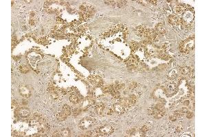 ALS2CR1 Mouse Monoclonal Antibody at 1/100 staining human ovarian cancer by IHC-P. (NIF3L1 anticorps)