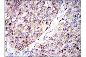 Immunohistochemical analysis of paraffin-embedded kidney cancer tissues using G6PD mouse mAb with DAB staining. (Glucose-6-Phosphate Dehydrogenase anticorps)