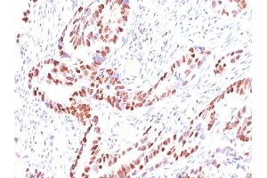 Formalin-fixed, paraffin-embedded human Colon Carcinoma stained with p57 Mouse Monoclonal Antibody (KIP2/880). (CDKN1C anticorps)