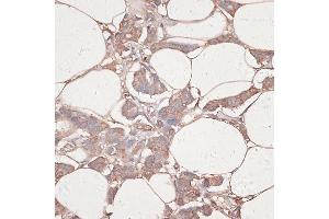 Immunohistochemistry of paraffin-embedded human breast cancer using L antibody (ABIN7268186) at dilution of 1:100 (40x lens).