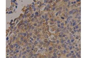 Immunohistochemical staining of human lung cancer with PGK1 monoclonal antibody, clone 14  at 1:100 dilution.