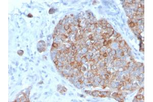 Formalin-fixed, paraffin-embedded human Prostate Carcinoma stained with STAT2 Mouse Monoclonal Antibody (STAT2/2650). (STAT2 anticorps)