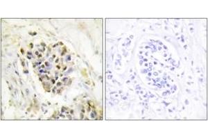 Immunohistochemistry analysis of paraffin-embedded human breast carcinoma tissue, using MED1 Antibody. (MED1 anticorps  (AA 641-690))