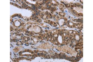 Immunohistochemistry of Human thyroid cancer using GGCX Polyclonal Antibody at dilution of 1:50