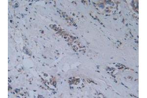 Detection of MAG in Human Breast Cancer Tissue using Polyclonal Antibody to Myelin Associated Glycoprotein (MAG)