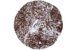 Strong TdT immunostaining in a thymoma