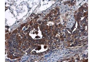 IHC-P Image DNase I antibody [N1C3] detects DNase I protein at cytoplasm in human cervical carcinoma by immunohistochemical analysis. (DNASE1 anticorps)