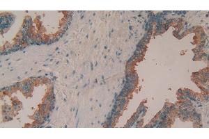 Detection of TIMP1 in Human Prostate Tissue using Polyclonal Antibody to Tissue Inhibitors Of Metalloproteinase 1 (TIMP1) (TIMP1 anticorps  (AA 25-207))