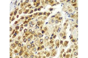 Immunohistochemistry of paraffin-embedded Human liver cancer using SND1 Polyclonal Antibody at dilution of 1:100 (40x lens).