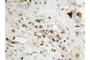 Immunohistochemistry analyzes of FoxC1/2 antibody in paraffin-embedded human prostate carcinoma tissue. (FOXC1 anticorps)