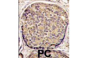 Formalin-fixed and paraffin-embedded human prostate carcinoma tissue reacted with PIK3CB polyclonal antibody  , which was peroxidase-conjugated to the secondary antibody, followed by DAB staining. (PIK3CB anticorps  (C-Term))