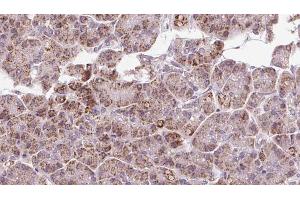 ABIN6273250 at 1/100 staining Human pancreas cancer tissue by IHC-P.