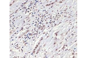 Immunohistochemistry of paraffin-embedded Human liver cancer using Phospho-Jak2(Y1007/1008) Polyclonal Antibody at dilution of 1:200 (40x lens). (JAK2 anticorps  (pTyr1007, pTyr1008))