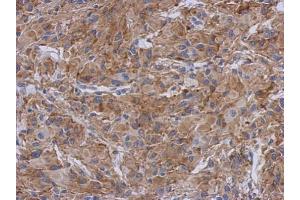 IHC-P Image Immunohistochemical analysis of paraffin-embedded U373 xenograft, using Radixin, antibody at 1:500 dilution.
