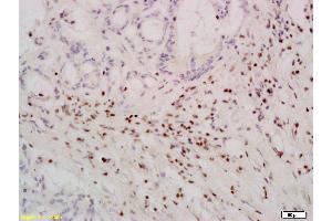 Paraformaldehyde-fixed, paraffin embedded Human Colon cancer Antigen retrieval by boiling in sodium citrate buffer (pH6. (TERT anticorps  (AA 601-750))