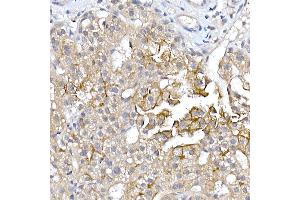 Immunohistochemistry of paraffin-embedded human liver cancer using  Rabbit pAb (ABIN6133588, ABIN6137055, ABIN6137056 and ABIN6224634) at dilution of 1:150 (40x lens). (AQP9 anticorps  (AA 50-150))