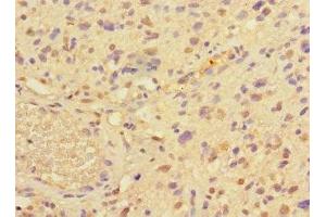 Immunohistochemistry of paraffin-embedded human glioma using ABIN7165067 at dilution of 1:100 (PRMT3 anticorps  (AA 311-529))