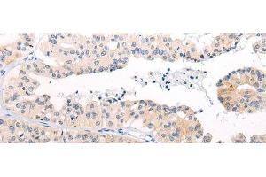 Immunohistochemistry of paraffin-embedded Human liver cancer tissue using ANAPC15 Polyclonal Antibody at dilution of 1:50(x200) (ANAPC15 anticorps)