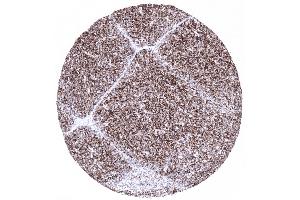 A strong CD1a immunostaining is seen in 80 of small lymphocytes in the thymic cortex