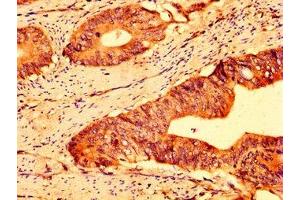 IHC image of ABIN7144938 diluted at 1:500 and staining in paraffin-embedded human colon cancer performed on a Leica BondTM system.