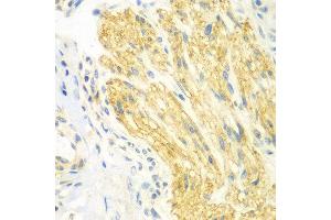Immunohistochemistry of paraffin-embedded human gastric cancer using PTK6 antibody at dilution of 1:100 (x400 lens). (PTK6 anticorps)