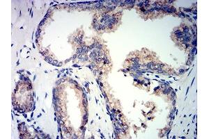 Immunohistochemical analysis of paraffin-embedded prostate cancer tissues using PSAP mouse mAb with DAB staining.