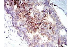 Immunohistochemical analysis of paraffin-embedded rectum cancer tissues using IGF1R antibody with DAB staining.
