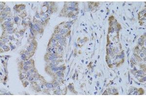Immunohistochemistry of paraffin-embedded Human liver cancer using CDKN1A Polyclonal Antibody at dilution of 1:100 (40x lens). (p21 anticorps)