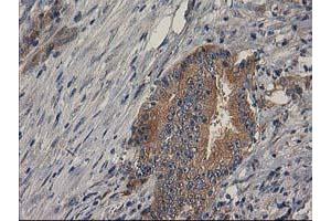 Immunohistochemical staining of paraffin-embedded Adenocarcinoma of Human colon tissue using anti-BCAR1 mouse monoclonal antibody. (BCAR1 anticorps)